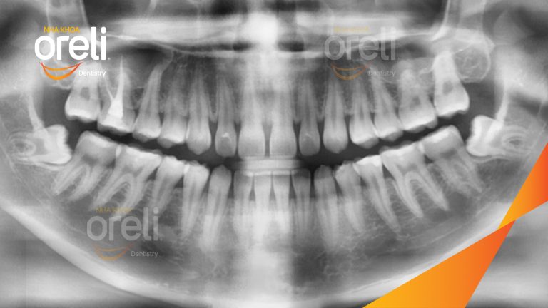 Ca Nhổ Răng Khôn Mọc Lệch Tại Buôn Ma Thuột | Nha khoa Oreli