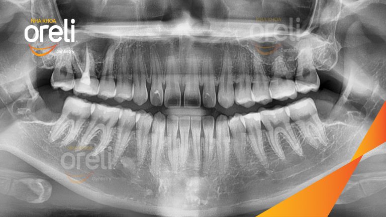 Ca Nhổ Răng Khôn Mọc Lệch Tại Buôn Ma Thuột | Nha khoa Oreli