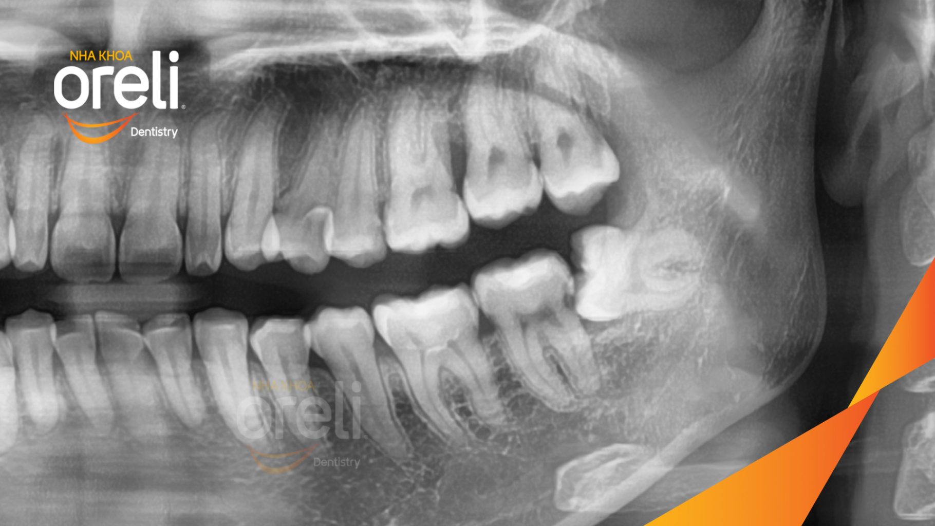 Trước điều trị: Răng khôn hàm dưới mọc lệch tại Oreli