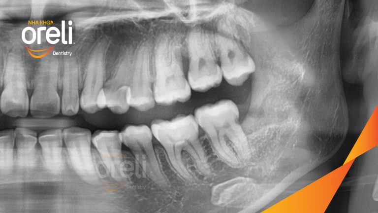 Ca Nhổ Răng Khôn Mọc Lệch Tại Buôn Ma Thuột | Nha khoa Oreli