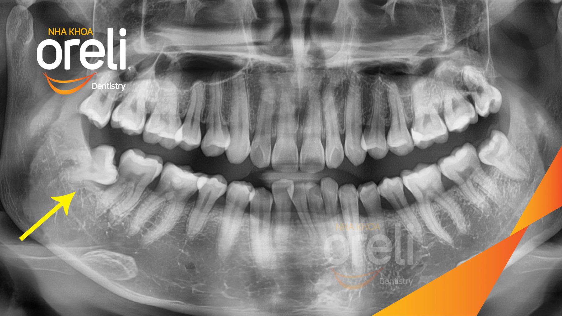 Trước điều trị:  Răng khôn hàm dưới mọc lệch tại Oreli