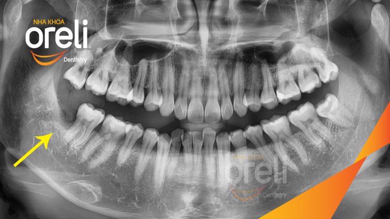 Ca Nhổ Răng Khôn Mọc Lệch Tại Buôn Ma Thuột | Nha khoa Oreli