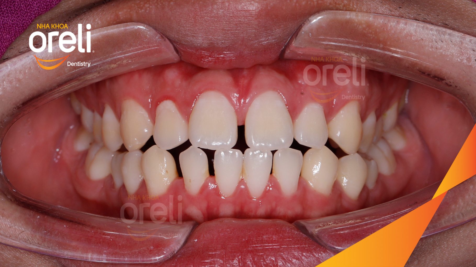 Trước điều trị: Khe thưa răng, hô hai hàm tại Nha khoa Oreli