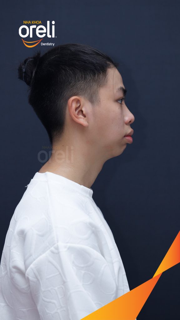Quá trình Niềng răng mắc cài không nhổ răng trong 2 năm tại Nha khoa Oreli