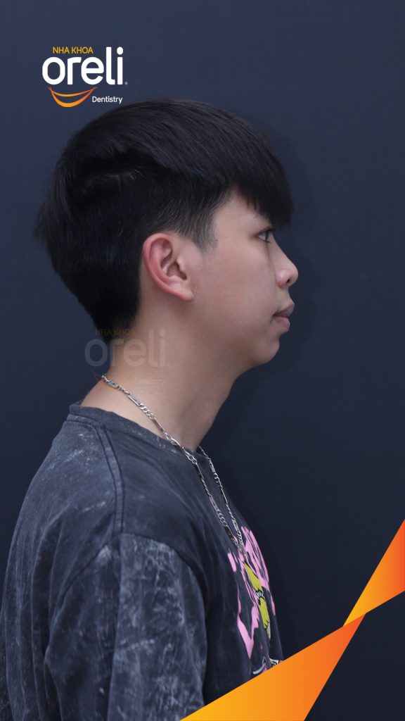 Thực hiện Niềng răng mắc cài không nhổ răng kéo dài 2 năm tại Nha khoa Oreli