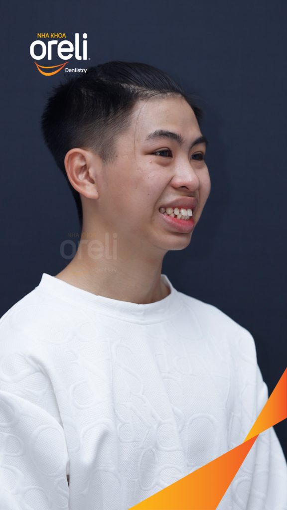 Trước điều trị: Khe thưa răng, hô hai hàm tại Nha khoa Oreli