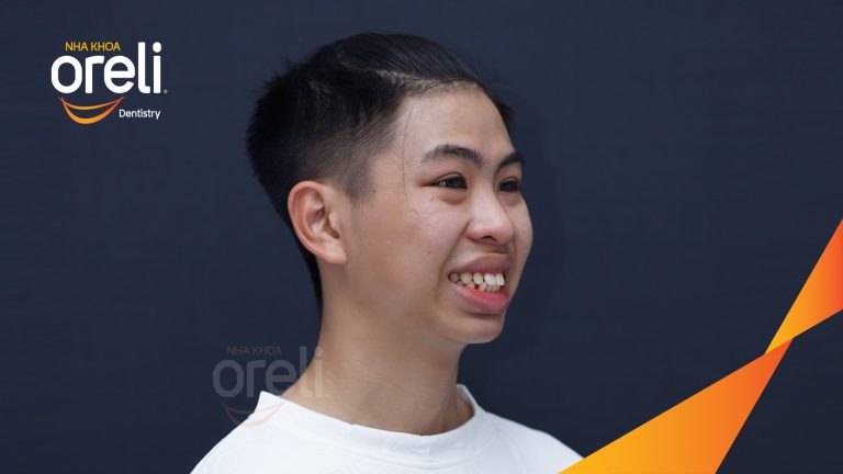 Ca niềng chỉnh hô và khe thưa cho nụ cười đẹp ở Oreli