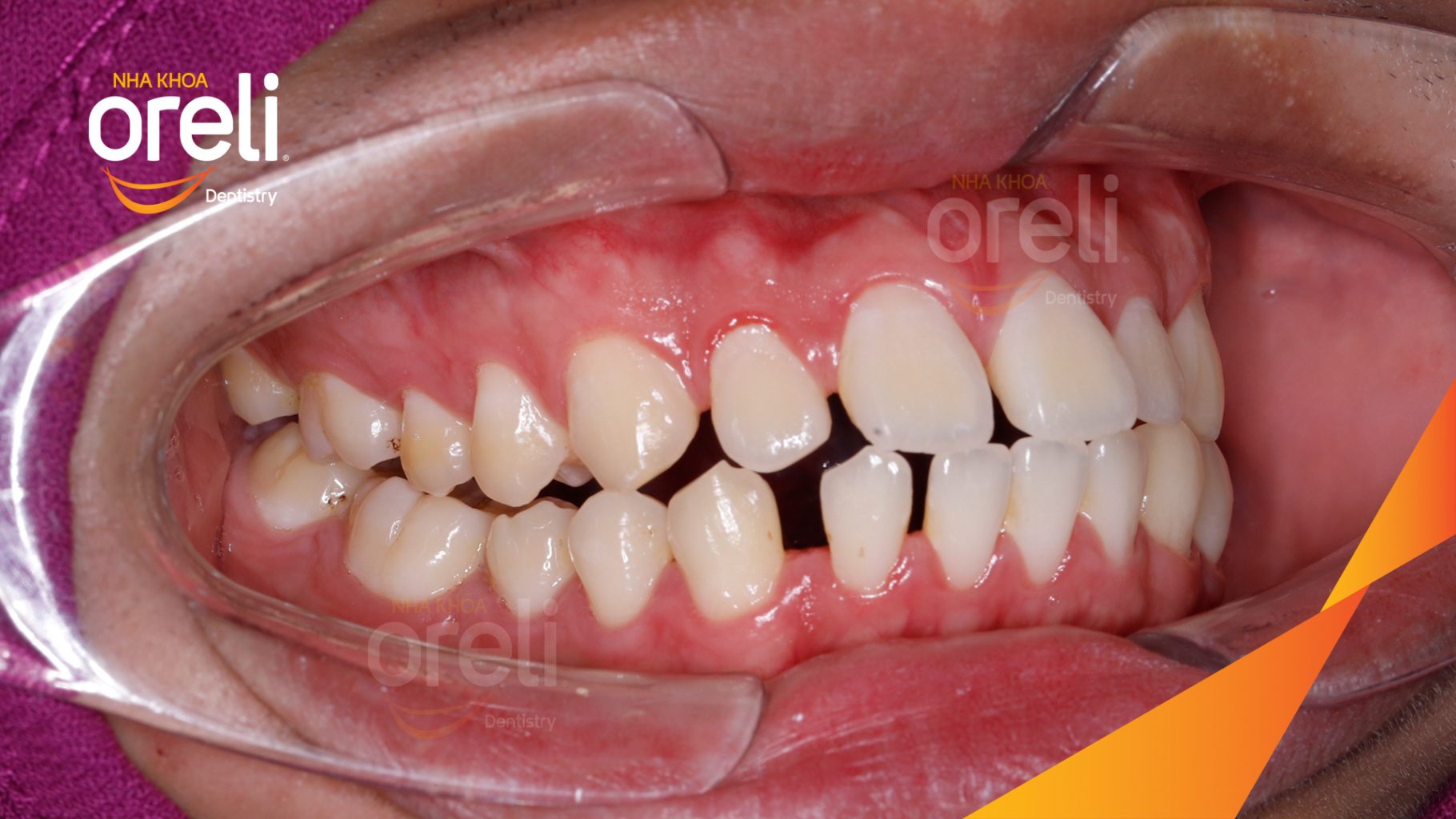 Quá trình Niềng răng mắc cài không nhổ răng trong 2 năm tại Nha khoa Oreli