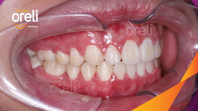 Ca niềng chỉnh hô và khe thưa cho nụ cười đẹp ở Oreli
