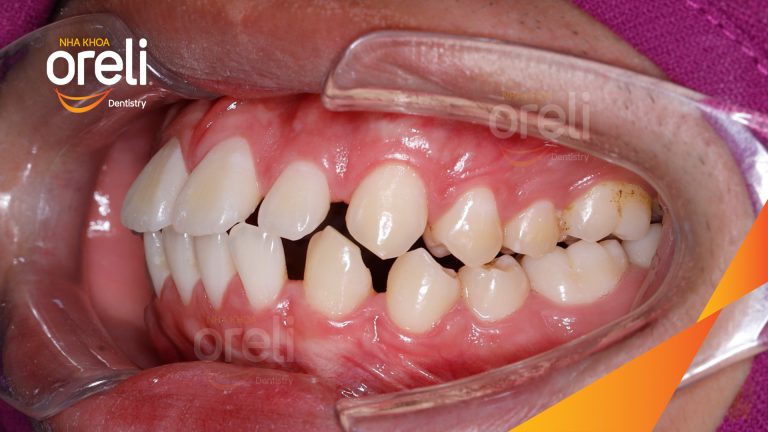 Ca niềng chỉnh hô và khe thưa cho nụ cười đẹp ở Oreli