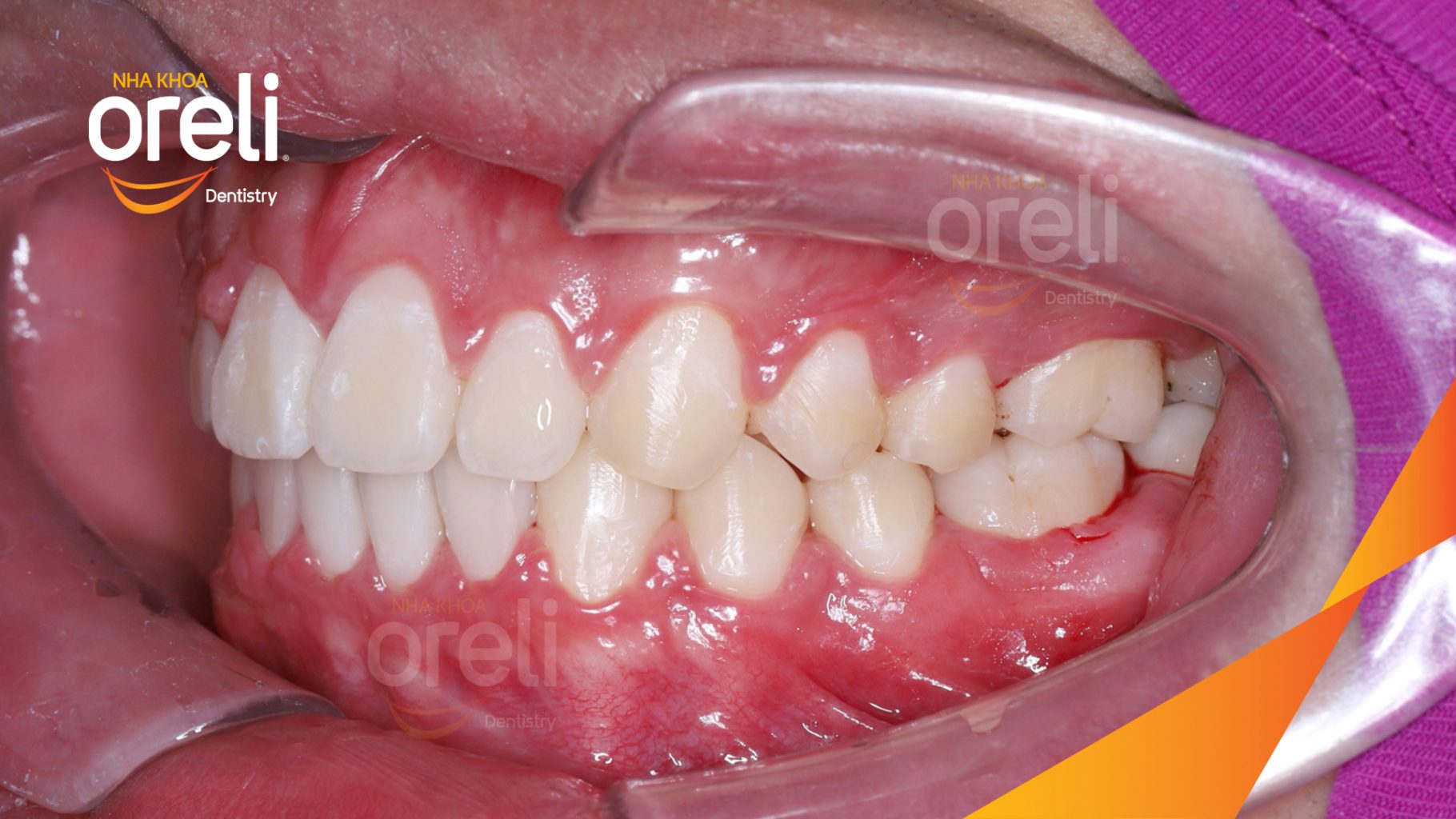 Kết quả đạt được sau 2 năm - Khớp cắn đúng bớt hô tại Nha khoa Oreli