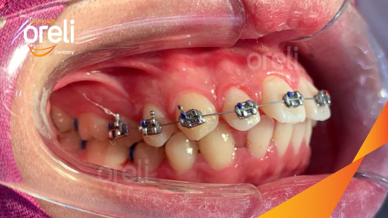 Ca niềng chỉnh hô và khe thưa cho nụ cười đẹp ở Oreli