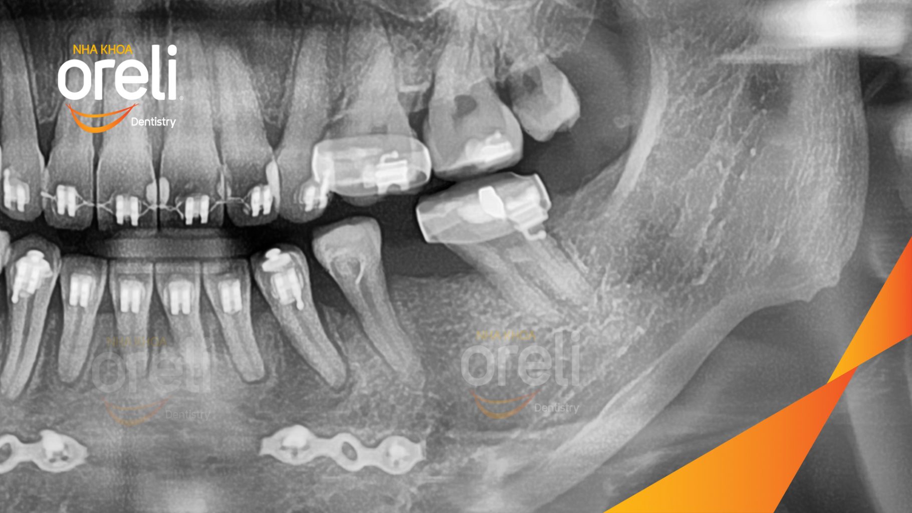 Trước điều trị: Mất răng hàm dưới tại Oreli