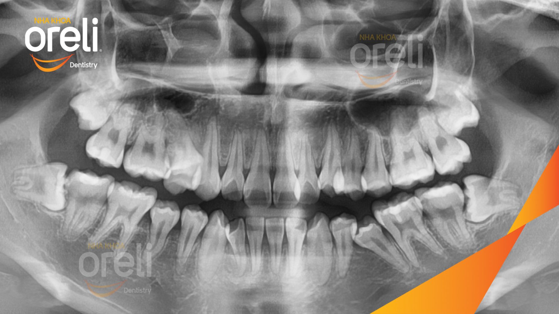Trước điều trị: Răng khôn hàm trên và dưới mọc lệch tại Oreli