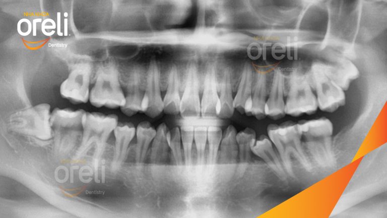 Ca Nhổ Răng Khôn Mọc Lệch Tại Buôn Ma Thuột | Nha khoa Oreli