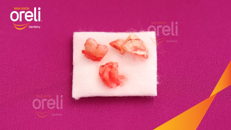 Ca Nhổ Răng Khôn Mọc Lệch Tại Buôn Ma Thuột | Nha khoa Oreli