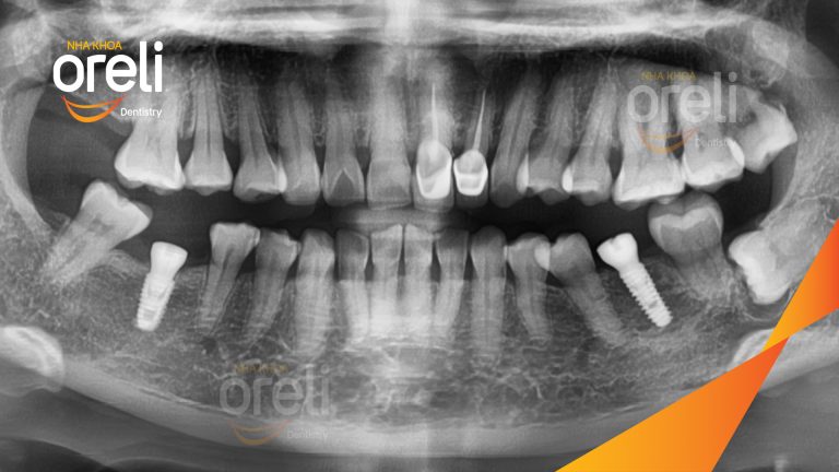 Ca Cấy Ghép Implant Hàm Dưới – Case thực tế tại Oreli