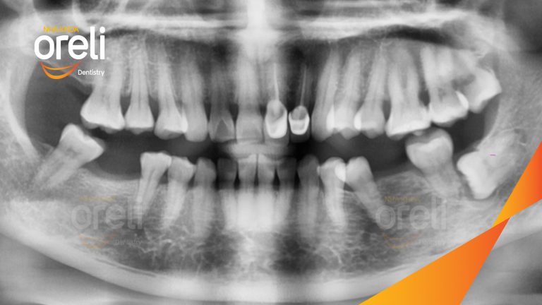 Ca Cấy Ghép Implant Hàm Dưới – Case thực tế tại Oreli