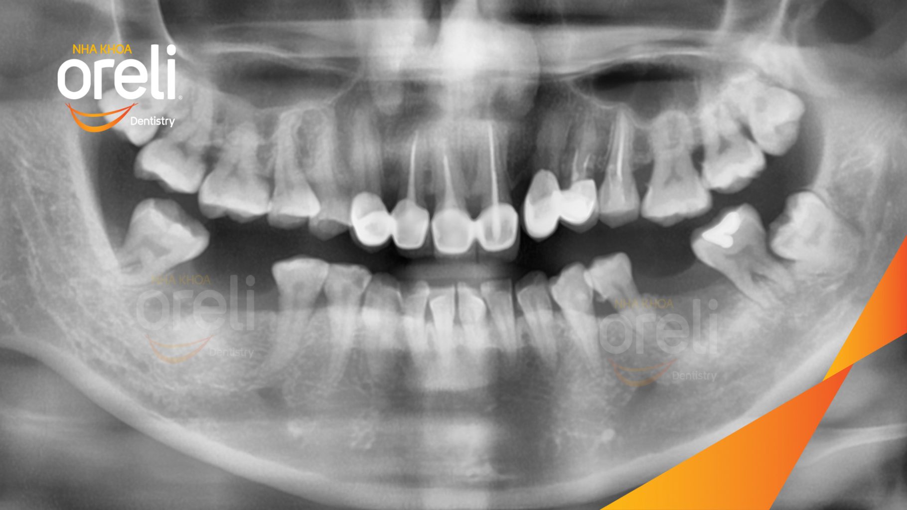 Trước điều trị: Mất răng hàm dưới tại Oreli