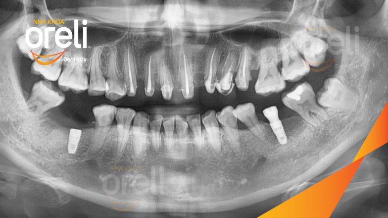 Ca Cấy Ghép Implant Hàm Dưới – Case thực tế tại Oreli