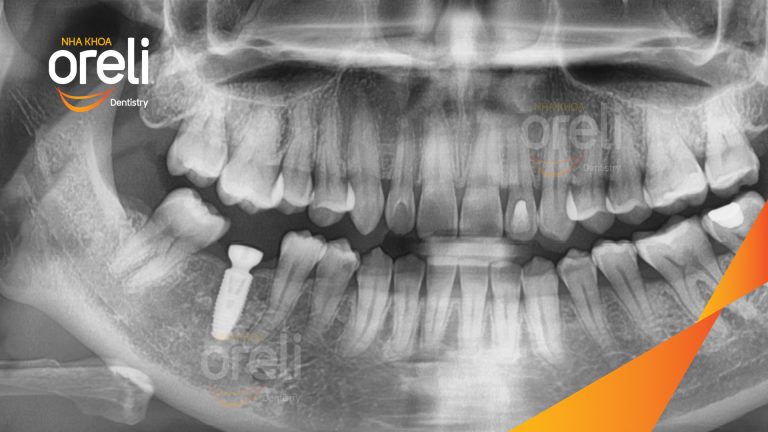 Ca Cấy Ghép Implant Phục Hồi Răng Tại Nha Khoa Oreli
