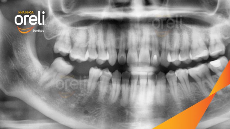 Ca Cấy Ghép Implant Phục Hồi Răng Tại Nha Khoa Oreli