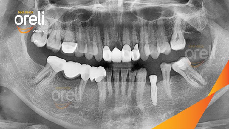 Ca Cấy Ghép Implant Hàm Dưới – Case thực tế tại Oreli