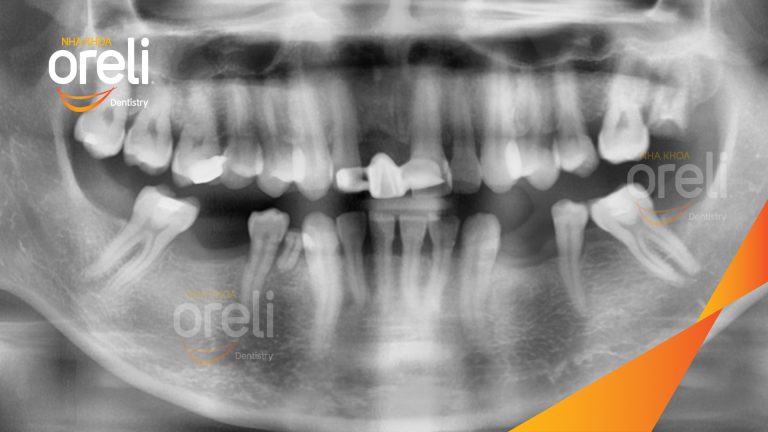 Ca Cấy Ghép Implant Hàm Dưới – Case thực tế tại Oreli