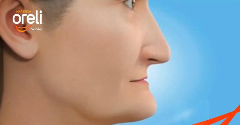 Tiêu xương hàm có làm thay đổi khuôn mặt không?