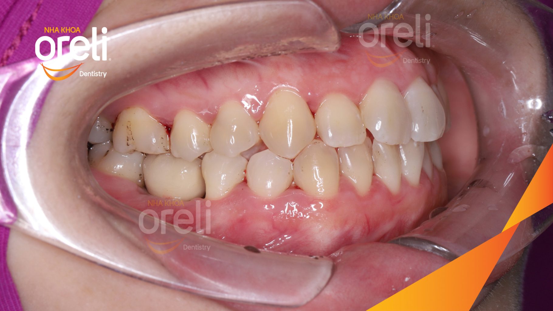 Kết quả đạt được sau 3 tháng - Hoàn thành đặt trụ Implant đúng vị trí mất răng tại Oreli
