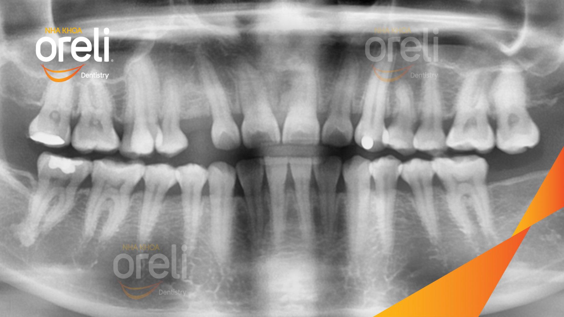 Trước điều trị: Mất răng hàm trên tại Oreli