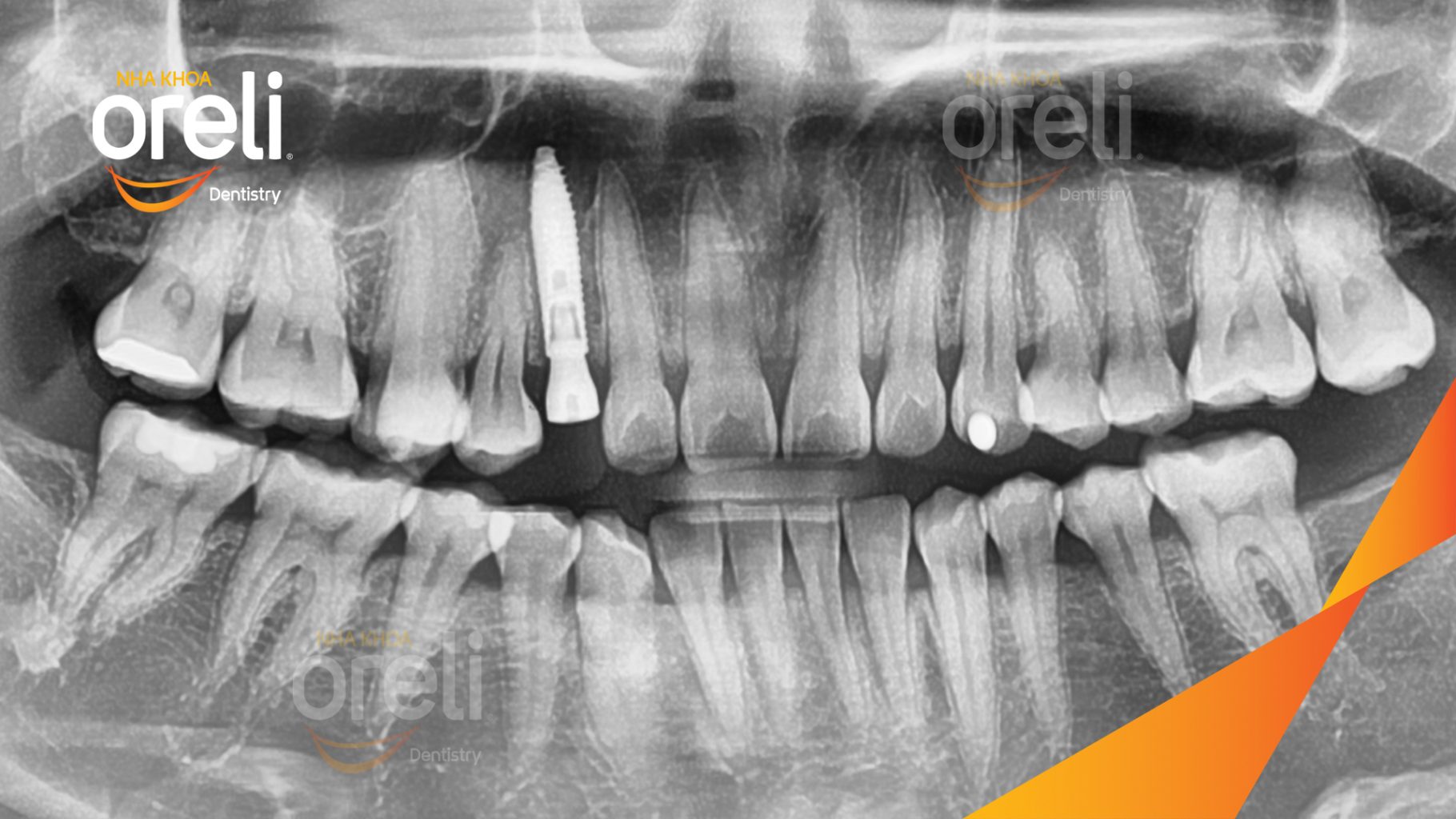 Mất răng hàm trên trước khi điều trị tại Oreli