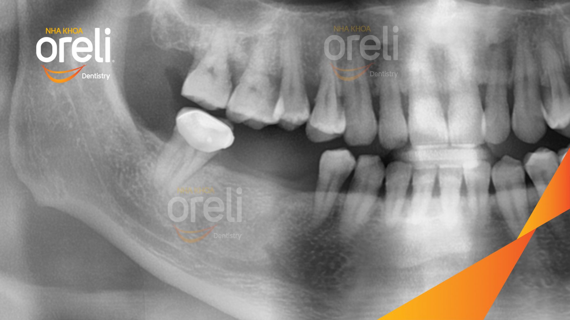 Trước điều trị: Mất răng hàm dưới tại Oreli