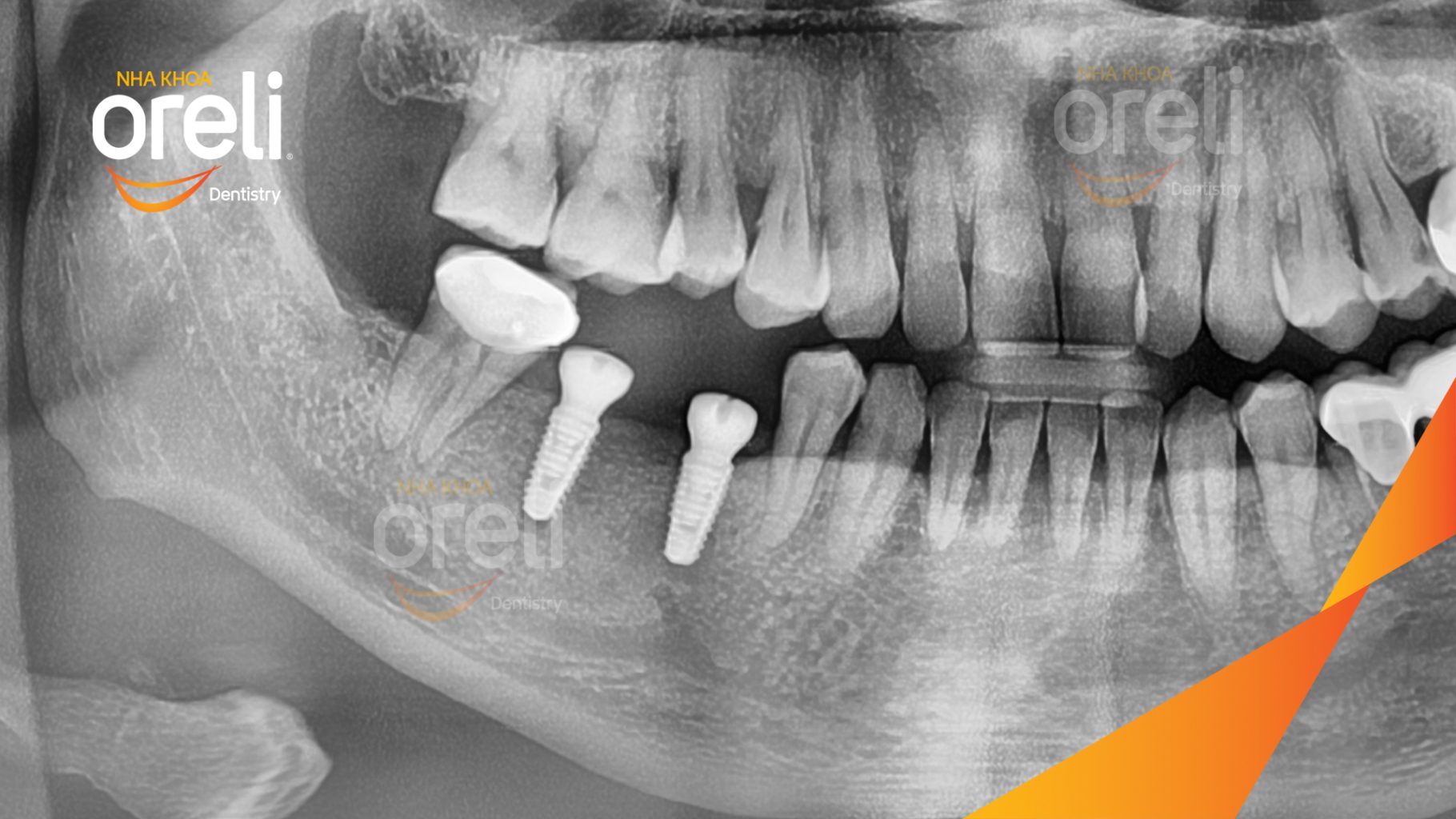 Mất răng hàm dưới trước khi điều trị tại Oreli
