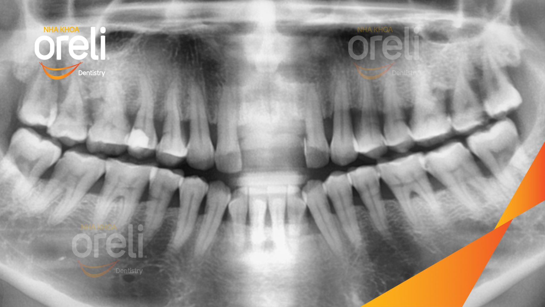Trước điều trị: Mất răng cửa tại Oreli