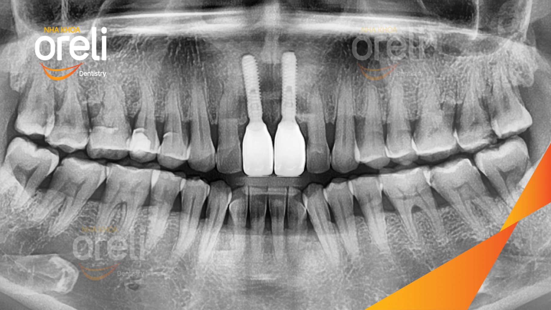 Mất răng cửa trước khi điều trị tại Oreli