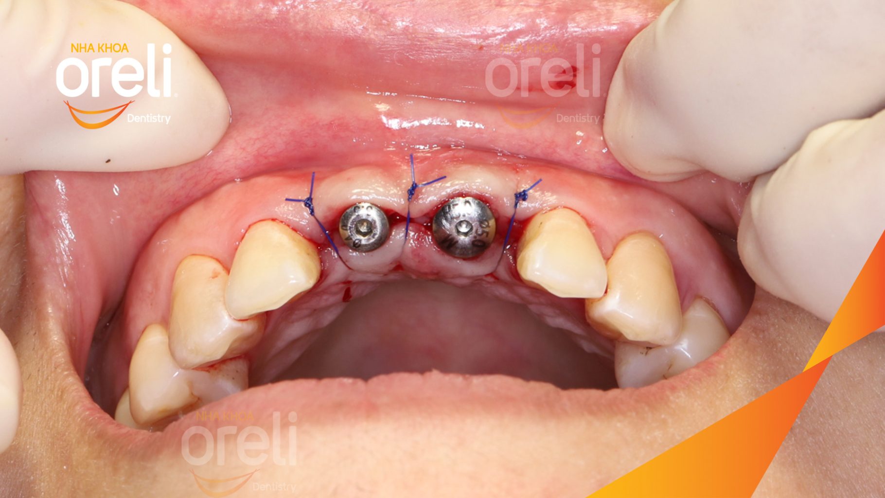 Quá trình Cấy ghép trụ Implant chính hãng vào vùng mất răng trong 3 tháng tại Oreli