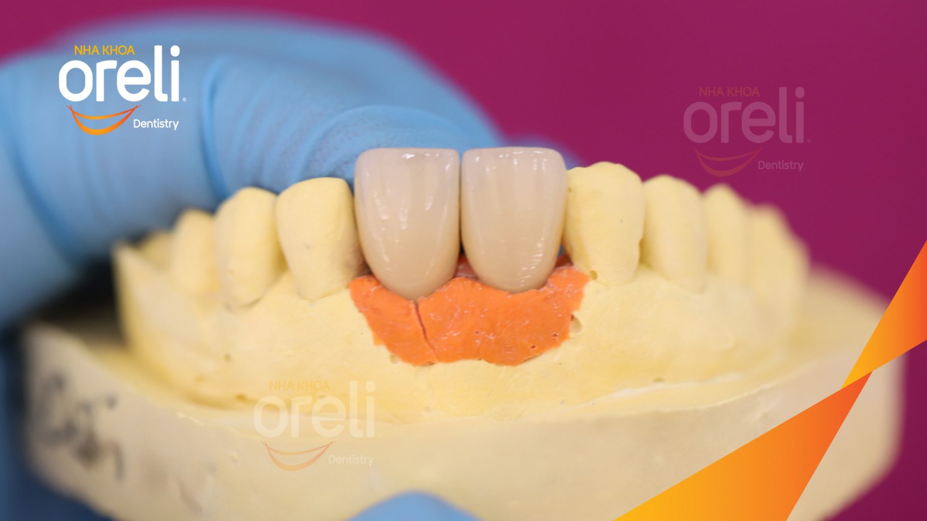 Kết quả sau 3 tháng: Phục hồi răng mất - ăn nhai chắc chắn và cười nói tự tin tại Oreli