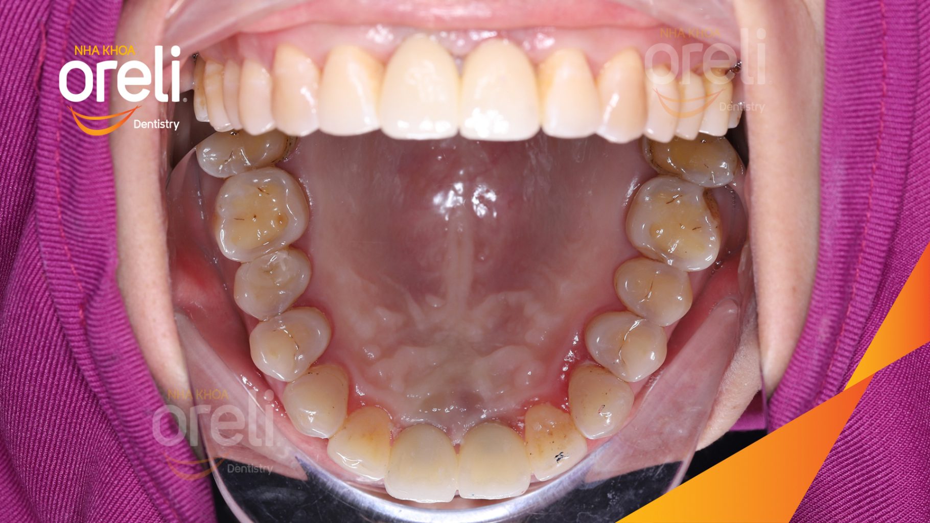 Kết quả đạt được sau 3 tháng - Phục hồi răng mất - ăn nhai chắc chắn và cười nói tự tin tại Oreli