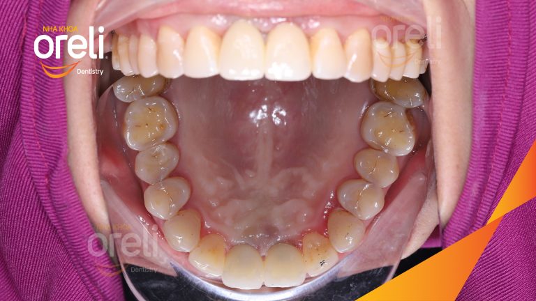 Ca Cấy Ghép Implant Phục Hồi Răng Tại Nha Khoa Oreli