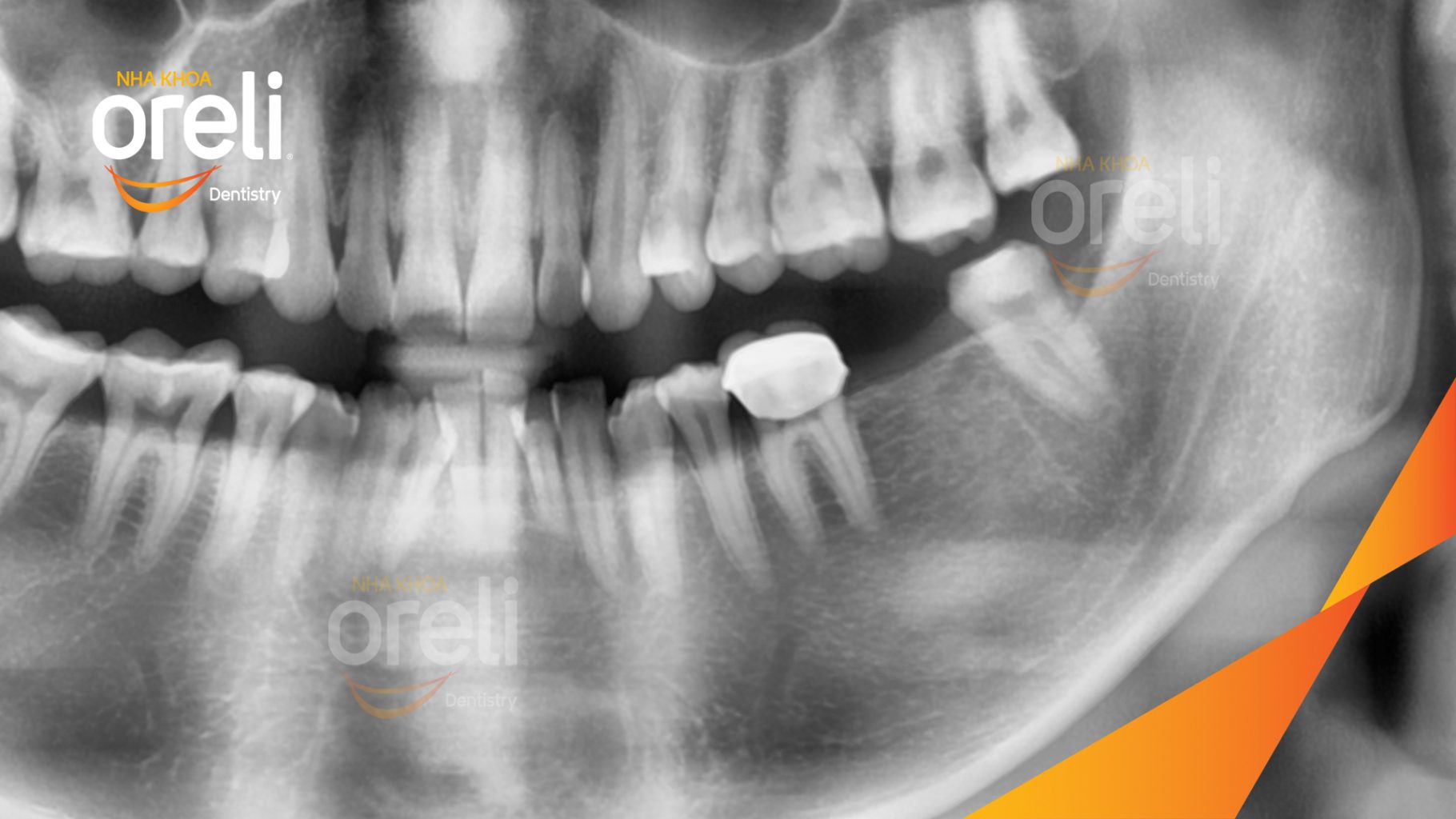 Trước điều trị: Mất răng hàm dưới tại Oreli