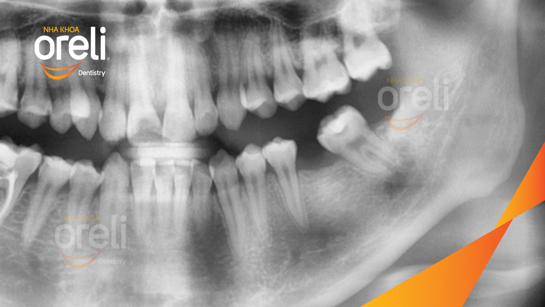 Trước điều trị: Mất răng hàm dưới tại Oreli