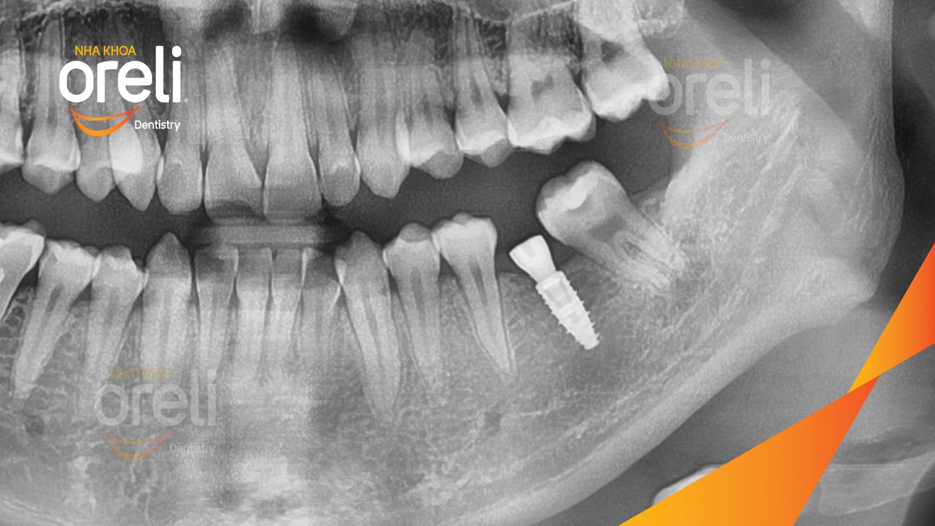 Mất răng hàm dưới trước khi điều trị tại Oreli