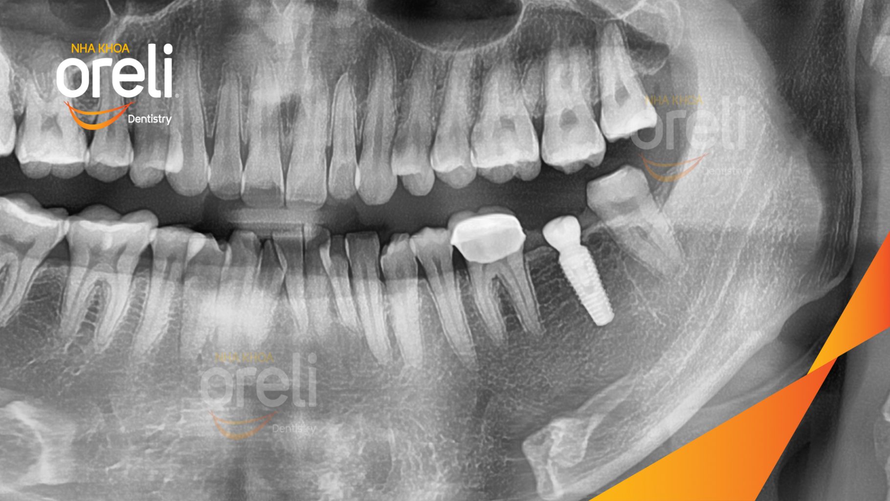 Mất răng hàm dưới trước khi điều trị tại Oreli