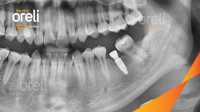 Ca Cấy Ghép Implant Phục Hồi Răng Tại Nha Khoa Oreli