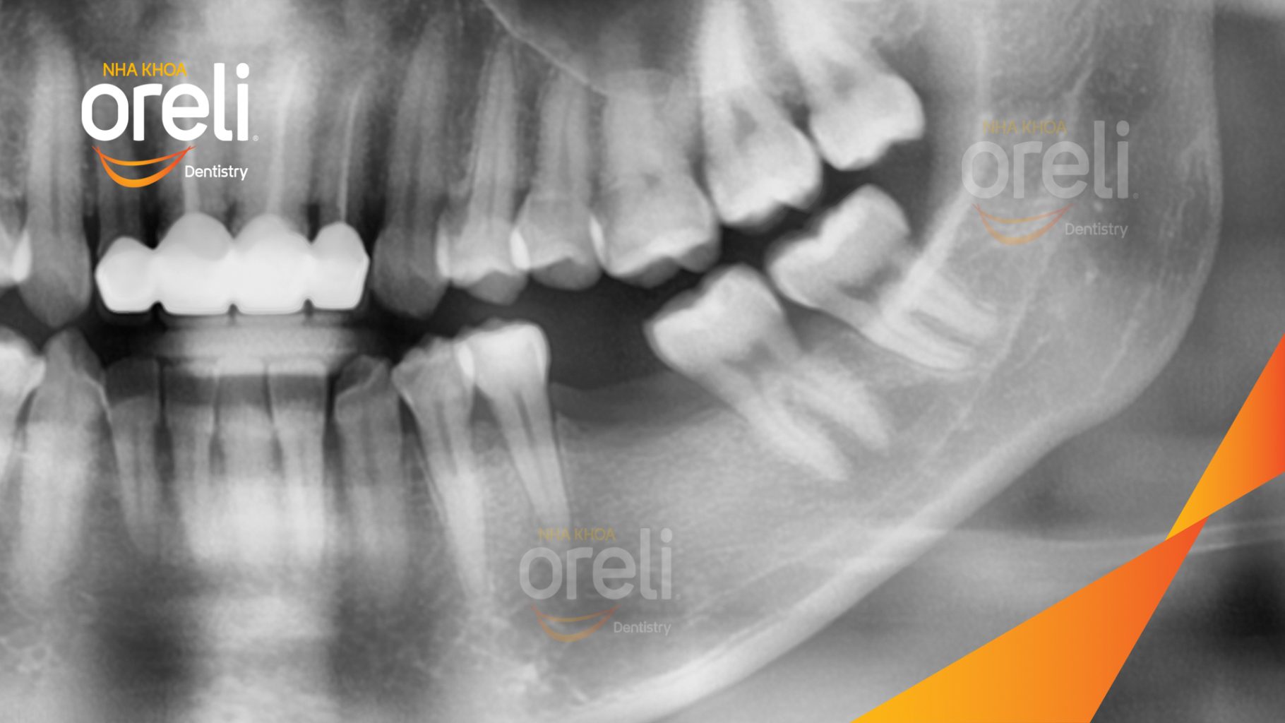 Trước điều trị: Mất răng hàm dưới tại Oreli