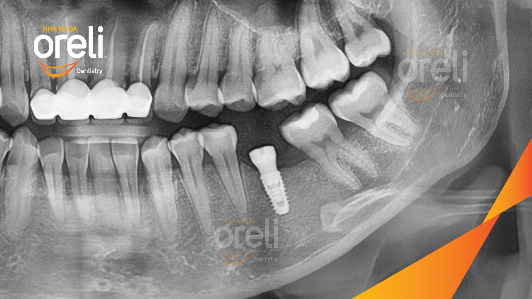 Mất răng hàm dưới trước khi điều trị tại Oreli