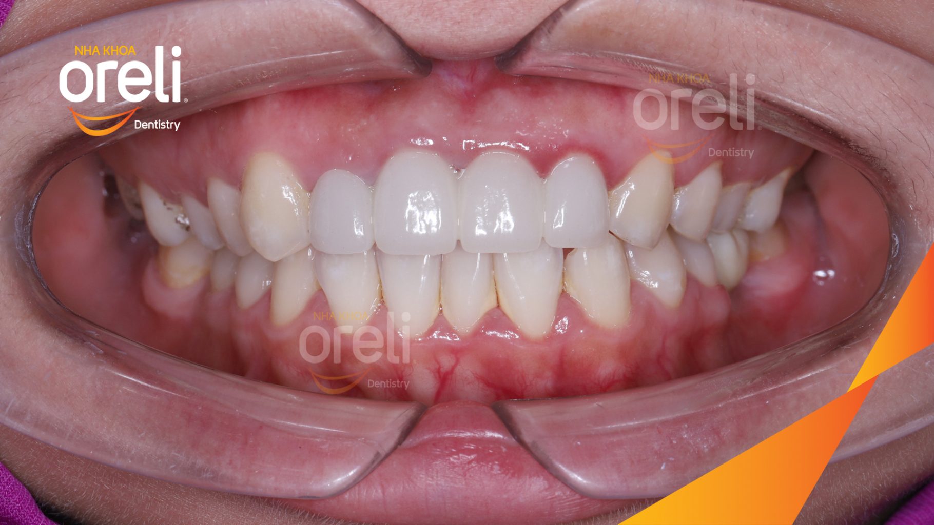 Kết quả sau 3 tháng: Hoàn thành đặt trụ Implant đúng vị trí mất răng tại Oreli
