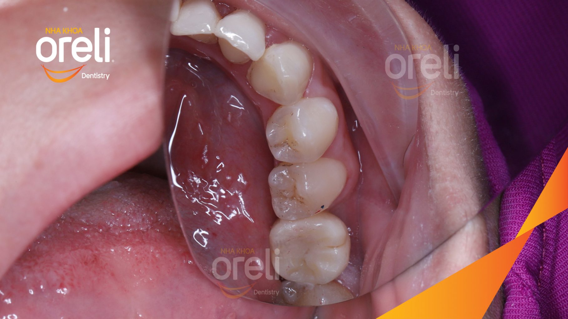 Kết quả đạt được sau 3 tháng - Hoàn thành đặt trụ Implant đúng vị trí mất răng tại Oreli