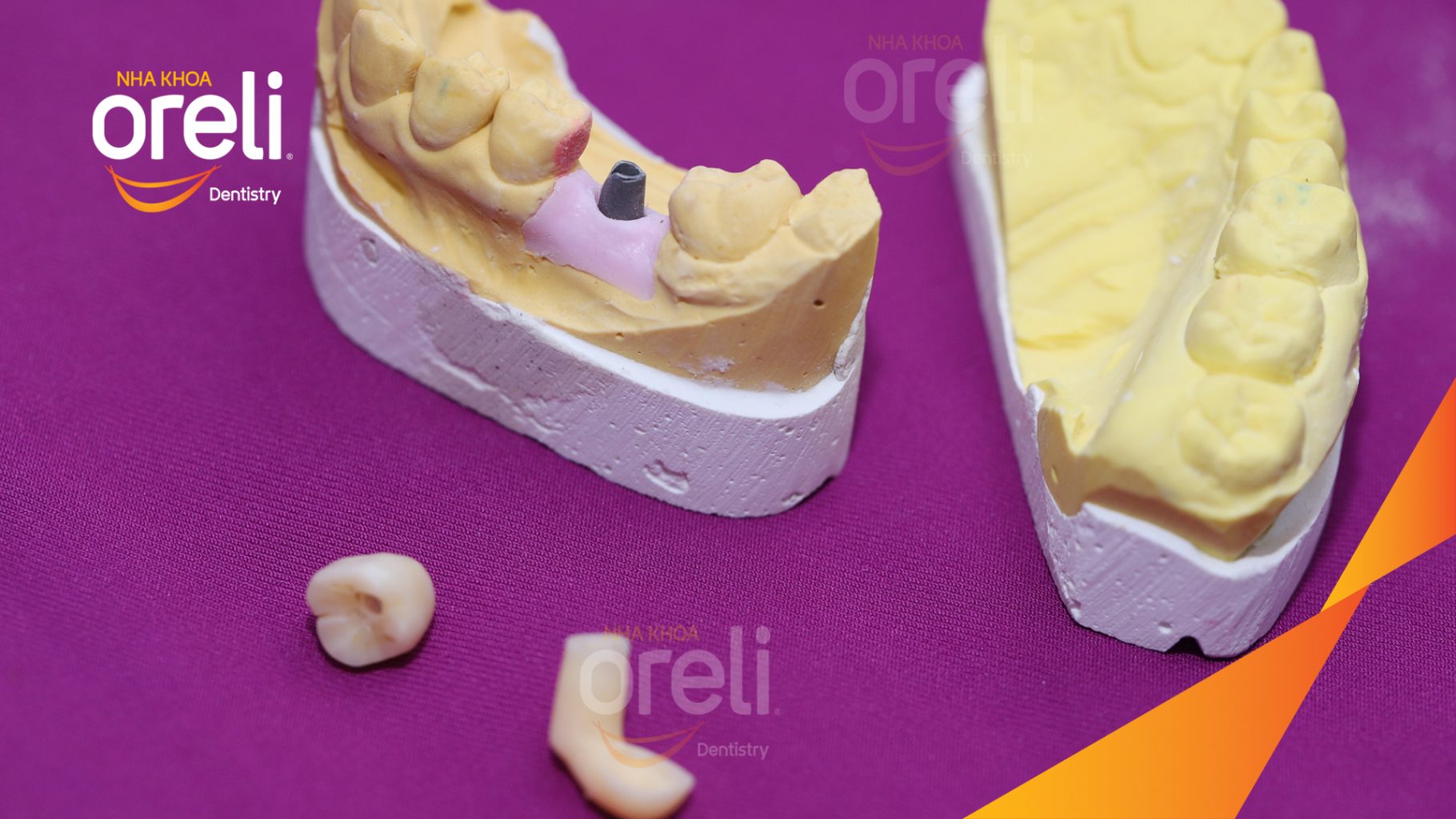 Thực hiện Cấy ghép trụ Implant chính hãng vào vùng mất răng kéo dài 3 tháng tại Oreli